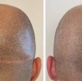 scalp micropigmentation treatment